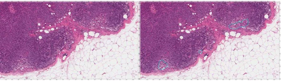 Figure 2: An area of one of the virtual slides, unannotated (left) and with the micrometastases 