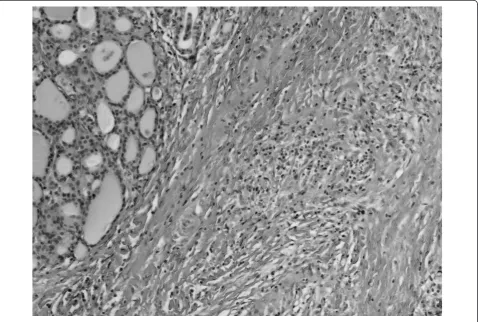 Figure 1 Thyroid parenchyma peripherally to dense connective tissue hyperplasia. HE 320 ×.