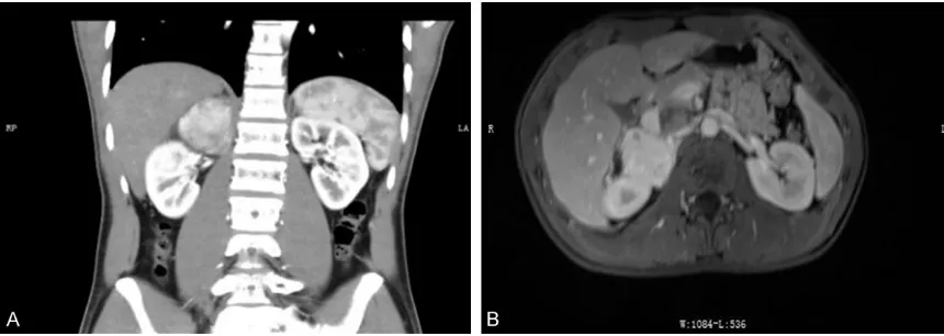 Figure 1. CT and MRI scan of the right adrenal gland. A. The CT scan; B. The MRI scan.