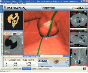 Figure 9 Presentation of a polyp candidate, which is a 35 mm sessile polyp in rectum according to the VC and OC reports.Abbreviations: OC, optical colonoscopy;  VC, virtual colonoscopy.