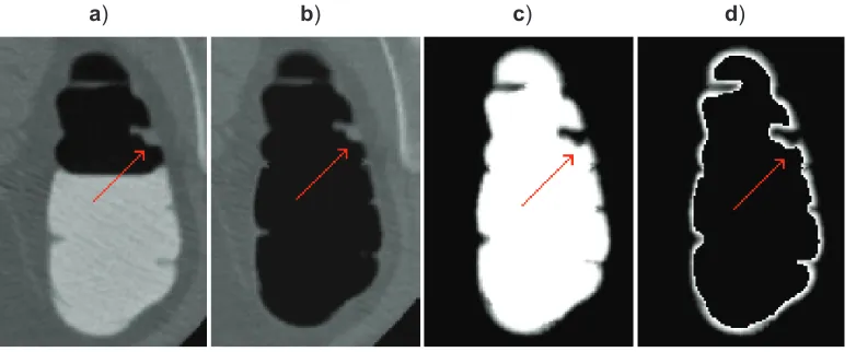 Figure 3 The process of VM extraction. The red arrow ﬂ ags an 8 mm polyp. a) Part of an original CTC slice