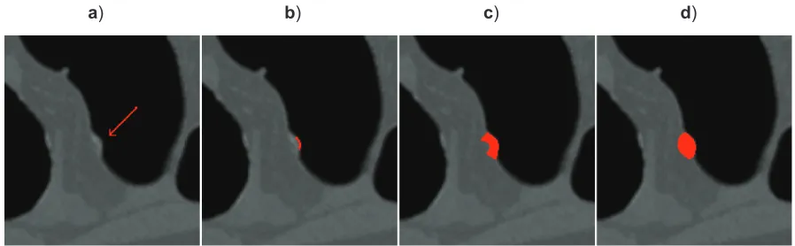 Figure 8 The VOI extraction for a 6 mm sessile polyp in a sigmoid colon. VOI generated with the conditional morphological dilation method.a) The original polyp (pointed by the red arrow)