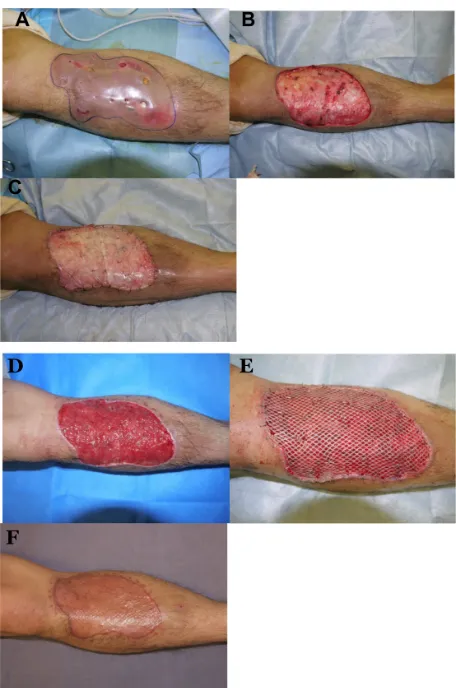Figure 1 (A) Nonhealing chronic pyoderma on the right lower limb before wound debridement