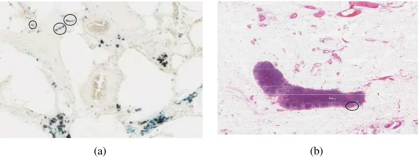 Figure 2. Extracts from histopathology slides: (a) three asbestos particles (circled; typically20 – 50 microns long) at 40× magnification, and (b) region of interest (circled; 1.1 × 0.1mm in size) in a lymph node at 5× magnification.