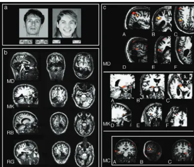 Fig. 1.(a) Example of stimuli used in experiment 3. (b) Anatomical MRI scans of the patients
