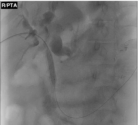 Figure 1 Percutaneous transhepatic balloon dilatation of a proximal common bile-duct stricture.