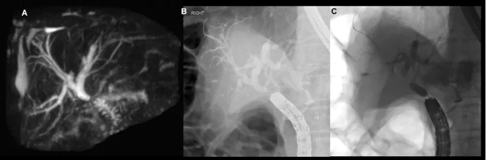 Figure 4 (A) Magnetic resonance cholangiopancreatography of anastomotic stricture at hepaticojejunostomy