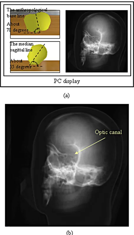 Figure 10. Positioning of the 3DCG phantom and the plane images of the left optic canal
