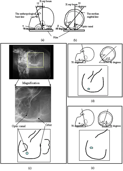 Figure 2. X-ray image and schemas of the left optic canal in the various position. (a) Lateral view; (b) Vertex view; (c) X-ray image and the schema of the X-ray image obtained by appropriate positioning; (d) Schema of X-ray image obtained by inap- 