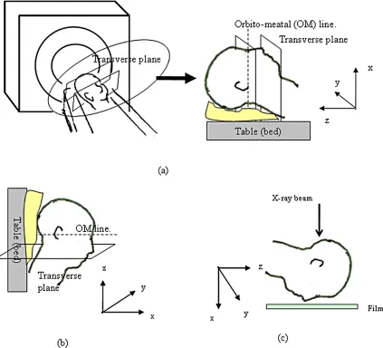 Figure 3. Positions of the skull phantom in the CT scanning and in the positioning practice