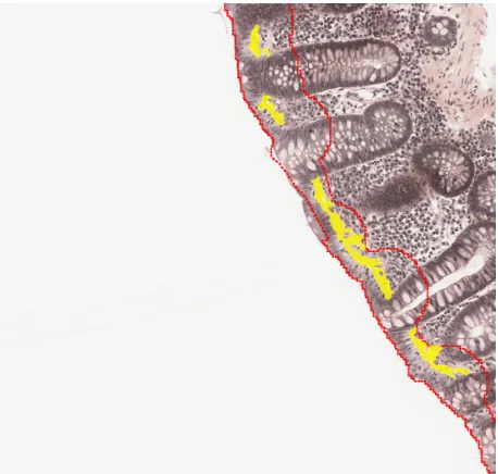 Figure 1 Identification of the biopsy material on the slides, identifying and excluding areas with tangential sectioning.Notes: the red outlined area is the region of interest for further analysis.