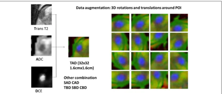 Figure 1. Combing multiparametric magnetic resonance imaging (mpMRI) images into RGB channels and augmentation with random rotation and translation.