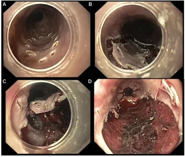 Figure 3 Four steps of endoscopic submucosal dissection: marking of lesion (A), mucosal incision (B), submucosal dissection (C), and the final result after en bloc resection (D).