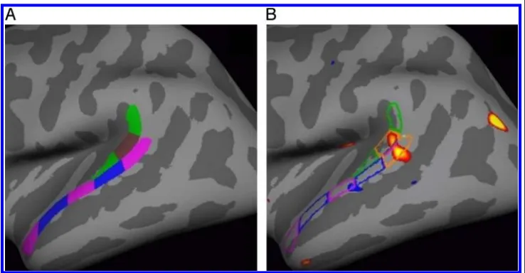 Figure 5. Method used togeometrically construct anROI to cover the STG cluster.(A) The PT was divided intothree sections along its longaxis (green–brown–greenlabels)