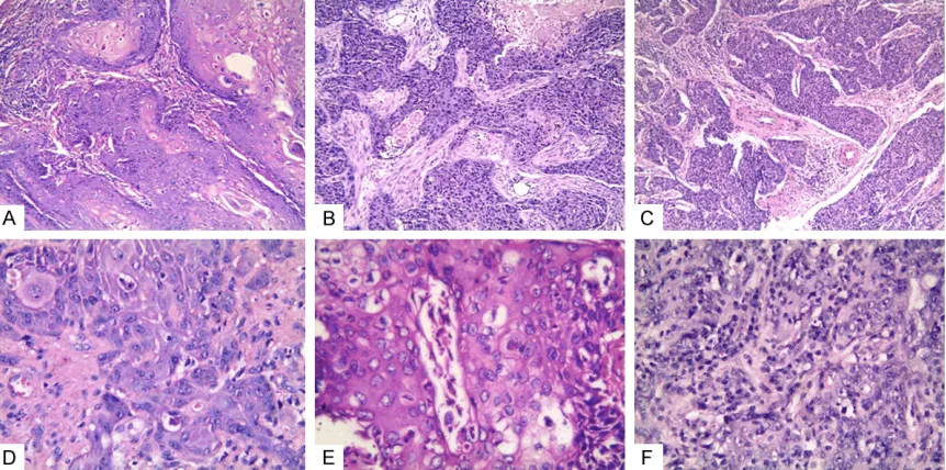 Figure 1. Presentation of histochemical staining of high-differentiation, moderate differentiation, and low differen-tiation
