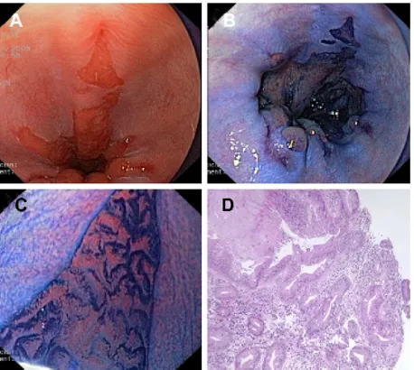 Figure 2 (A) Conventional endoscopic view of Barrett’s esophagus with concomitant esophagitis