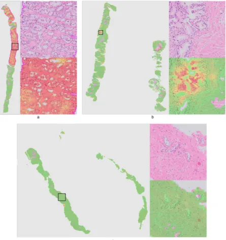 Figure 3.  Three representative examples of a whole slide prostate biopsy specimen. Each example (a–c)  shows the complete field of view with the cancer likelihood map as an overlay