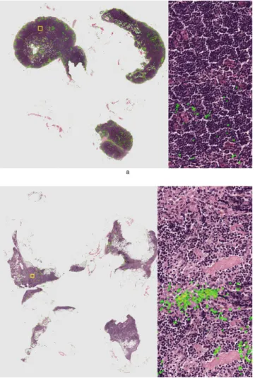 Figure 5.  Representative examples of normal lymph nodes from the consecutive set. Metastases likelihood  maps are overlaid on the original H&amp;E image