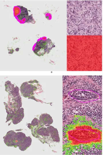 Figure 6.  Representative examples of lymph nodes with macro-metastases (top image) and a single  micro-metastasis (bottom image) from the test set