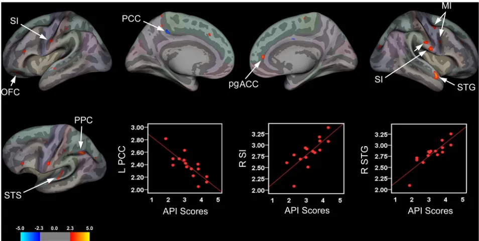 Fig 2. Brain Areas Showing Significant Associations between Cortical Thickness and Abdominal Pain Severity