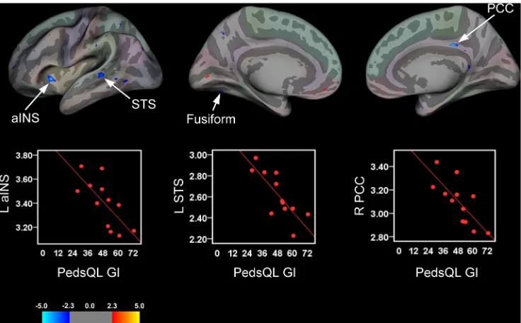 Table 5. Summary of Significant Clusters for Brain Areas Showing a Relationship between Cortical Thickness, Disease Duration and PainIntensity.