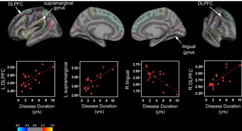 Fig 4. Cortical Thickness and Disease Duration in Pediatric IBS Patients. Brain areas showing a significant relationship betweencortical thickness and disease duration rendered onto an inflated averaged study-specific brain for the left (L) and right (R) h