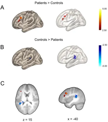 Fig 6. Group Effects for the Seed-based Functional Connectivity Analysis for the Posterior CingulateCortex