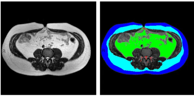Figure 1MRI imaging of abdominal fat tissues compartments. The subcutaneous fascial planesubcutaneous fat; light blue, deep subcutaneous fat; green, visceral adipose tissue; and red, non-classilisted above
