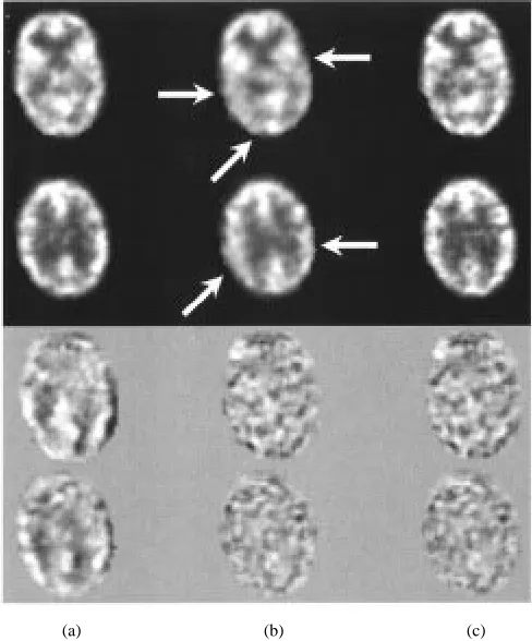 Fig. 7.The top two rows illustrate reconstructions for (a) motion-free data,(b) motion-corrupted data, and (c) motion-corrected data
