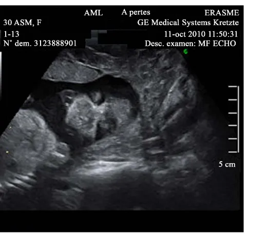 Figure 1. 23 wks, sagittal view, absence of nose, prominent upper lip.                              