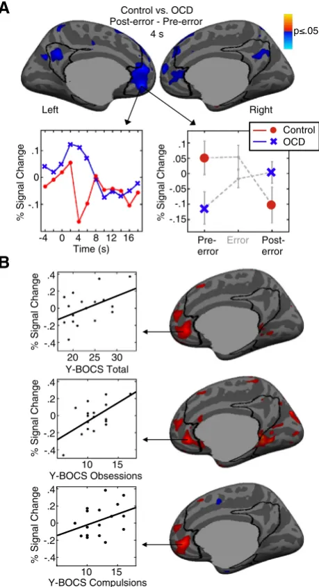 Fig. 3. Preparatory fMRI activation of the default network and its relation to symptom se-verity