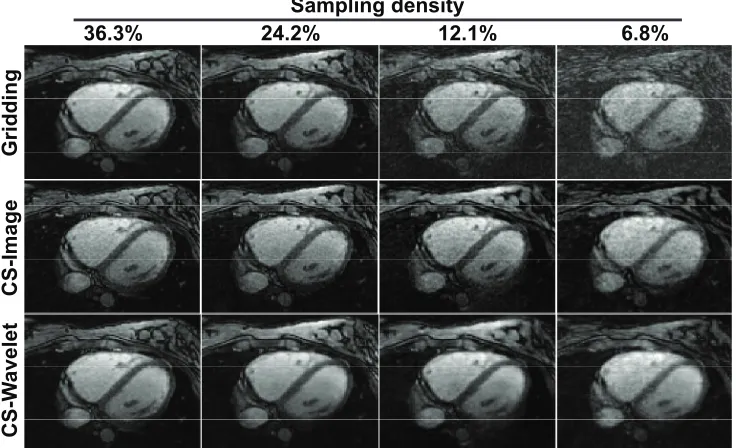 Figure 2.6: Example slices of axial views from 3D whole-heart images reconstructed byconventional 3D gridding reconstruction and iterative CS reconstruction (with 1000iterations for image domain regularization and 500 iterations for wavelet domainregulariz