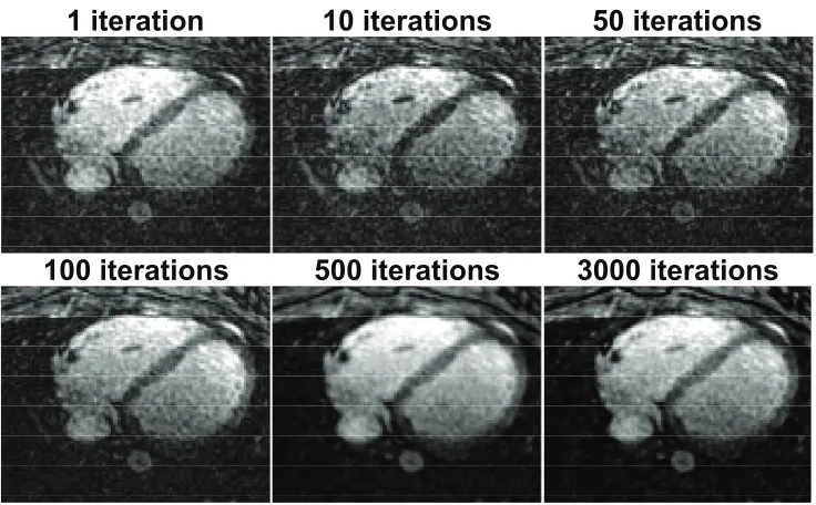 Figure 2.8: An example slice from 3D data-set (sampling density = 6.8%) of thecoronary arteries reconstructed using CS with image domain regularization at diﬀer-ent iterations