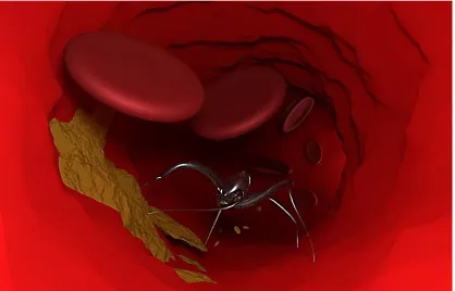 Figure 1.8 Conceptual artwork of a 'molecular surgeon' removing plaque from a blood vessel