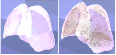 Figure 12. Full exam showing 3D detection model of a hyper- inflated region.  