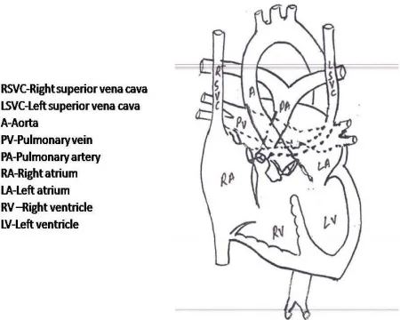 Figure 1. Patient no one showing double outlet right ventri-cle with large subaortic perimembranous ventricular septal 