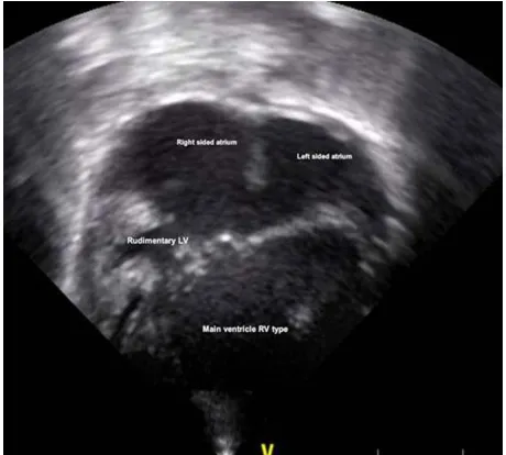 Figure 8. Echocardiogram of patient no five showing un-balanced atrioventricular septal defect with rudimentary left ventricle