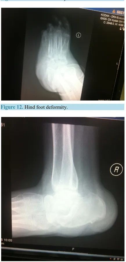 Figure 11. Hind foot deformity.                                                    