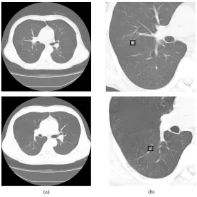Figure 1. Sample images from the database used in this study. (a) Original images of the lung, (b) left part of the lung extracted from (a)