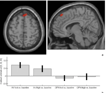 Figure 1. CIPN-myeloma patients demonstrated a) hypo-activation of superior frontal gyrus during heat-pain stimulation,compared with healthy volunteers.estimates and 90% CI at co-ordinate 6, 39, 48 for both healthy volunteer and CIPN-myeloma patient groups