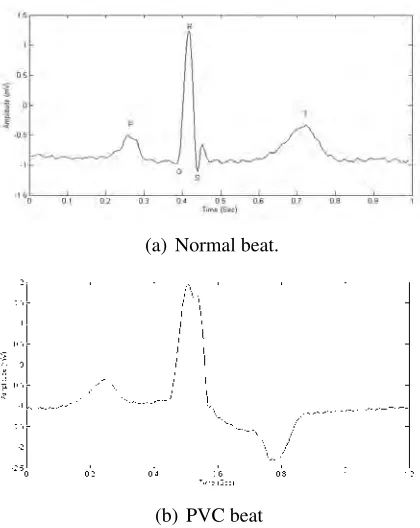 Figure 2.12: Typical ECG beat: