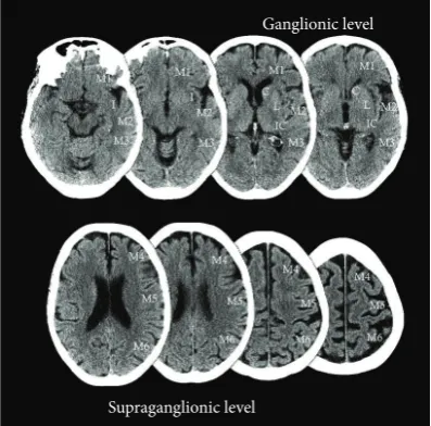 Figure 1: Obtained from http://www.aspectsinstroke.com/, demonstrating the ASPECTS scoring methodology, axial NCCT images showingthe MCA territory regions as defined by ASPECTS
