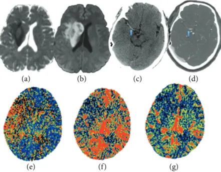 Figure 2: (a) and (b) ADC map and DWI map with restricted diffusion in the setting of cytotoxic edema from acute ischemic infarct inright MCA territory