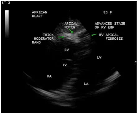 Figure 2. Parasternal long axis view showing a dense RV apical fibrosis.                                                  