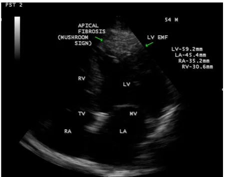 Figure 5. This figure shows LV apical fibrosis, dilated left ventricle and normal left atrium