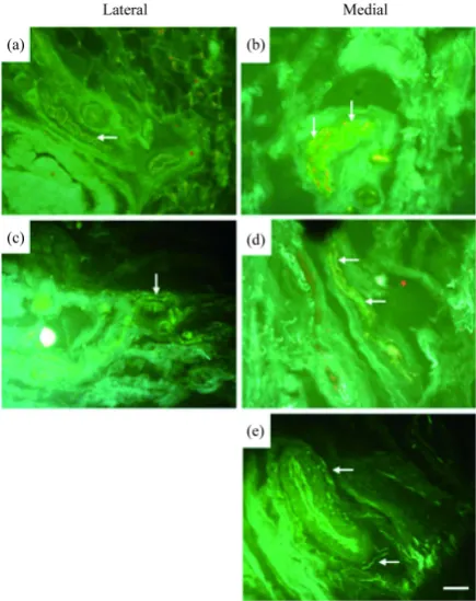 Figure 3. Fluorescence photomicrographs showing double staining of GAP-43 with SP (a, b) and CGRP (c, d) and NPY (e) from the lateral (a, c) medial (b, d, e) compart-ments from OA knee joint