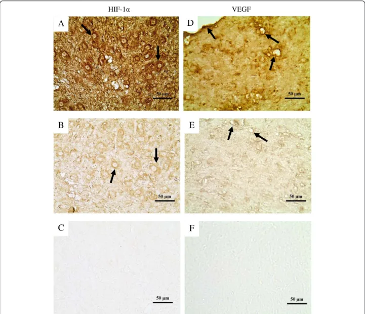Figure 6 Representative images of immunohistochemical expression of hypoxia inducible factor 1 α and vascular endothelial growth