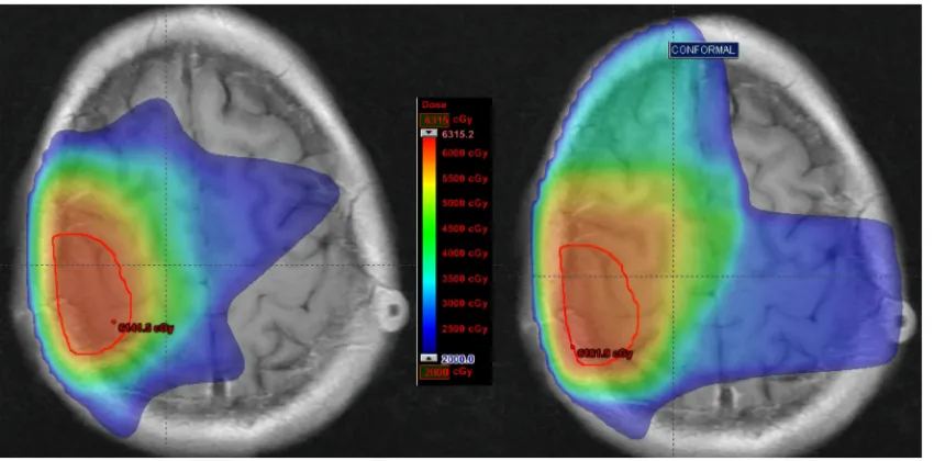 Figure 5. Brain v20 (%brain receiving >20 Gy): Comparison of IMRT and 3D CRT plans for patient #4