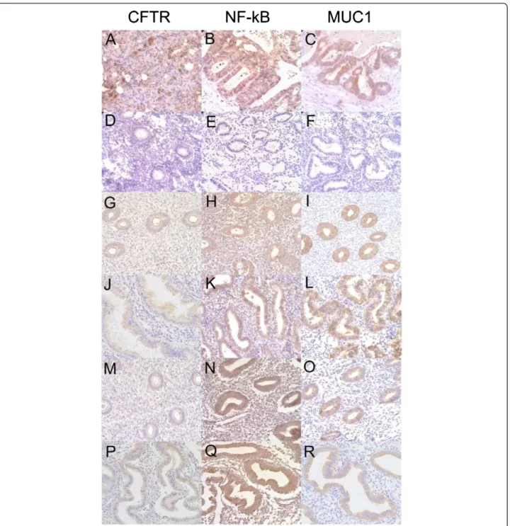 Figure 1 CFTR, NF KappaB and MUC1 immunohistochemical staining in the endometrium. Representative images of positive control CFTR, NF KappaB and MUC1 immunostaining (A-C) and negative control CFTR, NF KappaB and MUC1 immunostaining (D-F), respectively