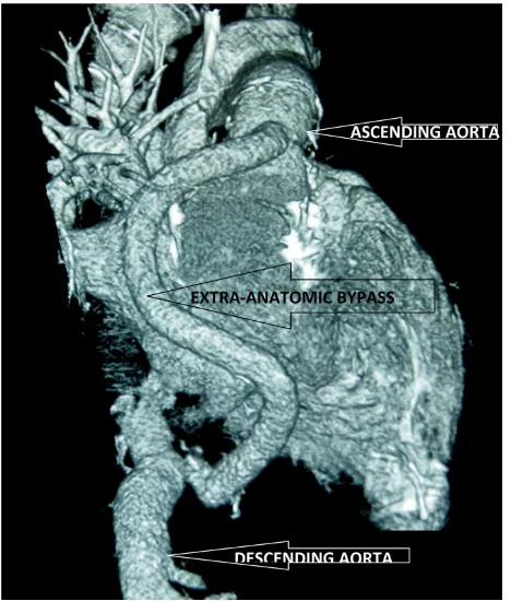 Figure 1. Operative view of the extra-anatomic aortic bypass. The tube is tunnelled around the right heart border